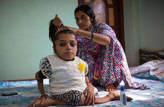 印女孩患罕见成骨不全症 骨头碎裂1000余次